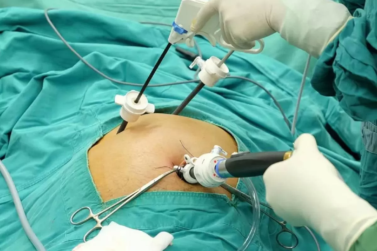 Laparoscopic Surgery